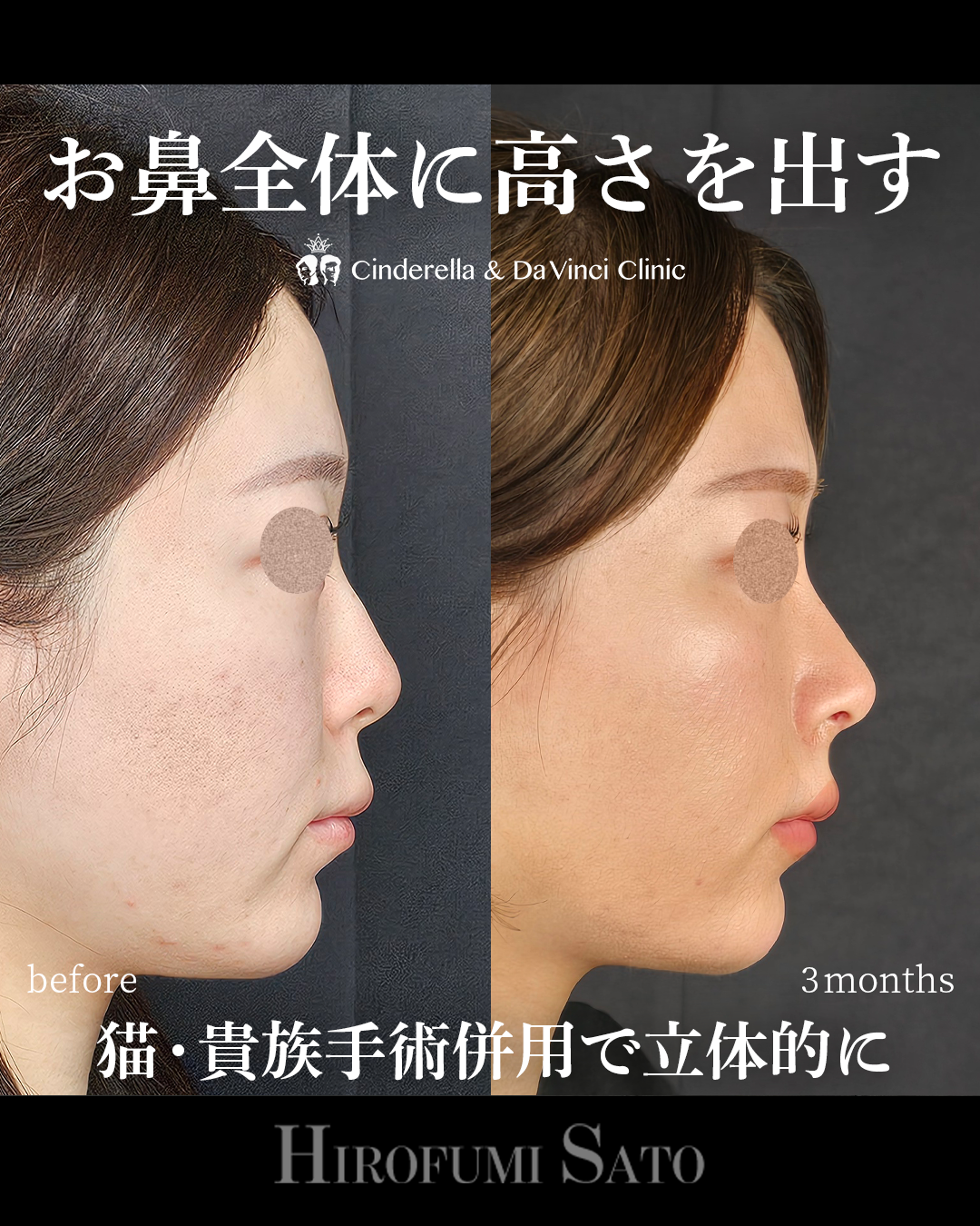 鼻を全体的に高くの画像