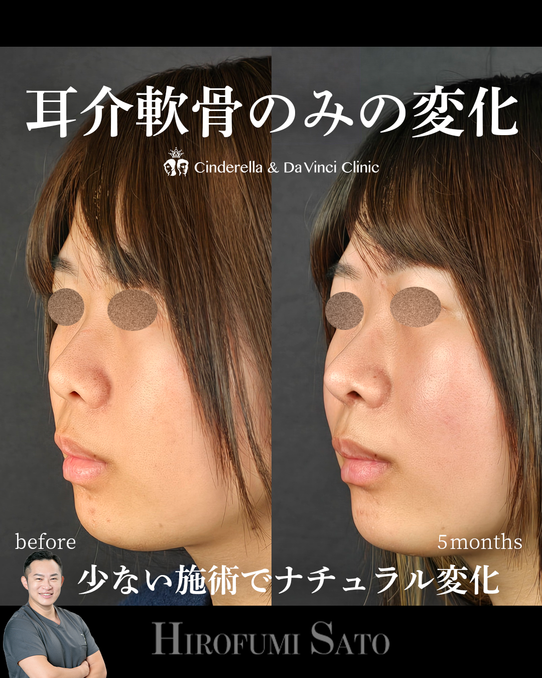 少ない施術でナチュラルアプデの画像