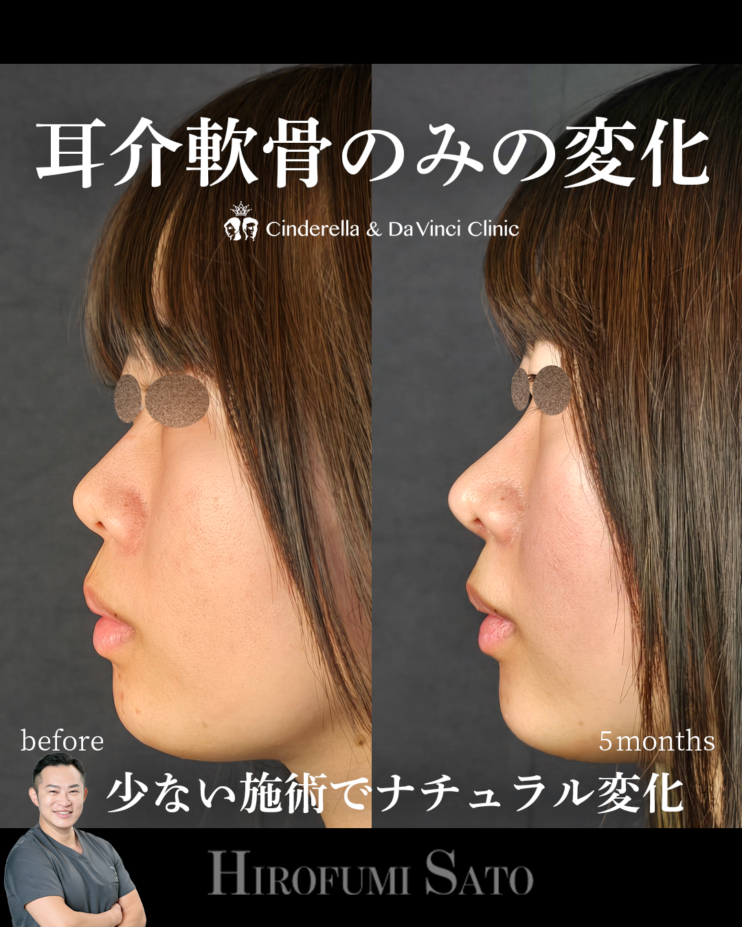 少ない施術でナチュラルアプデの画像