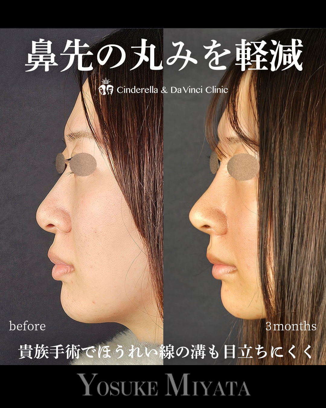 鼻先の丸みを軽減