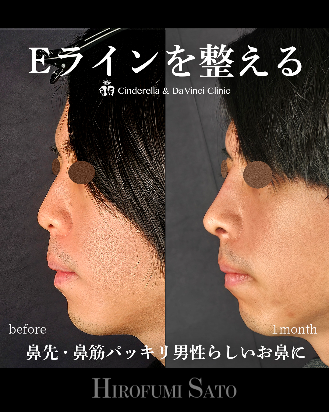 男性の鼻整形
