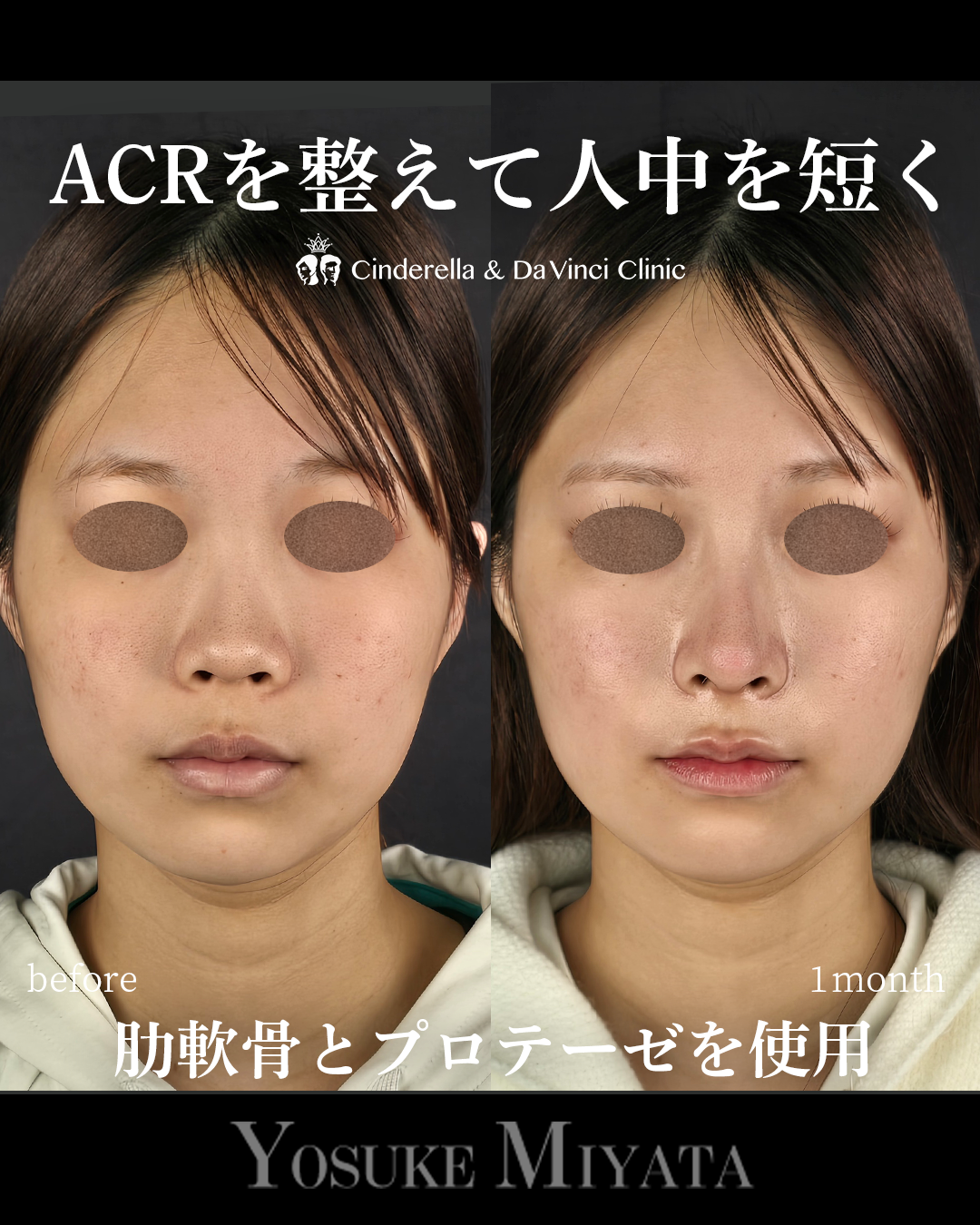 ACRを整えて人中を短く