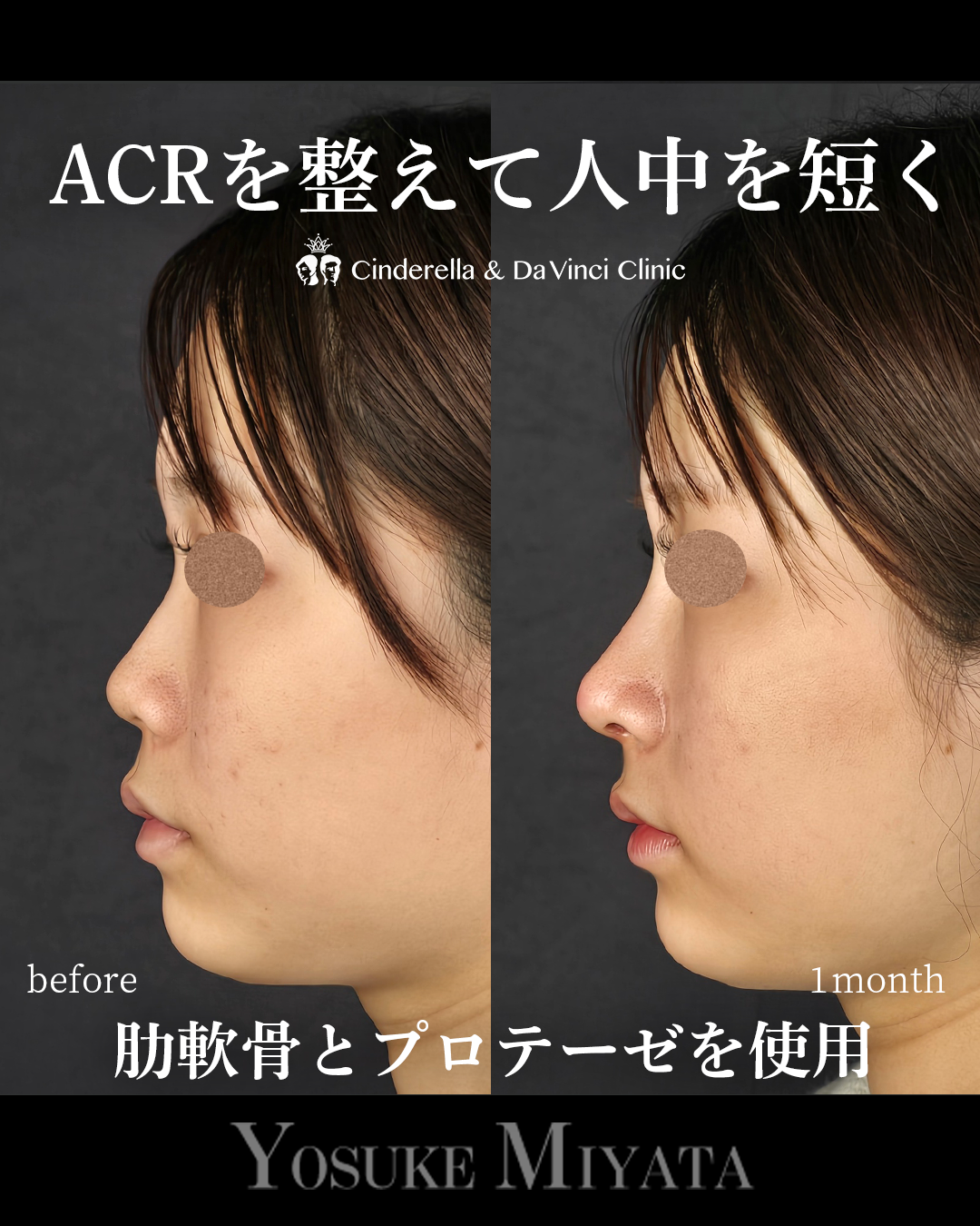 ACRを整えて人中を短くの画像