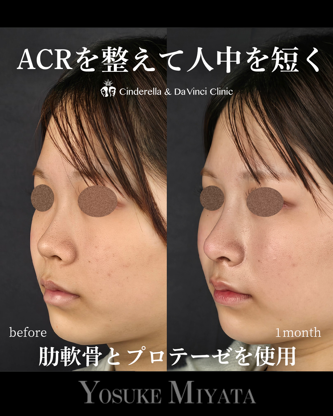 ACRを整えて人中を短くの画像