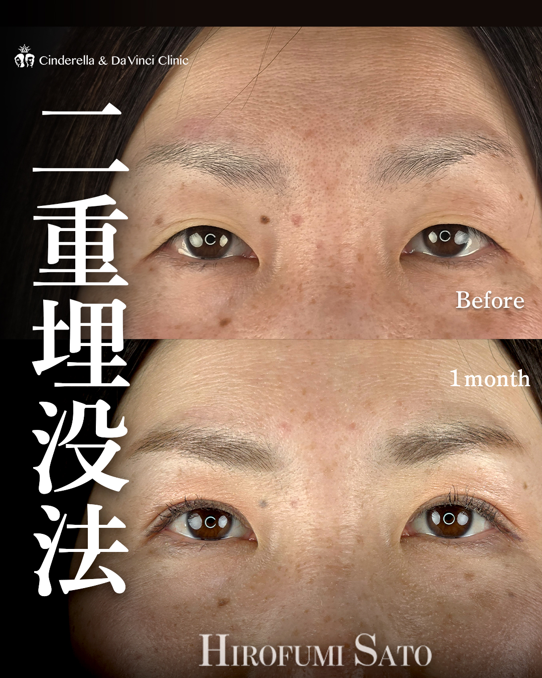 末広二重でもぱっちり