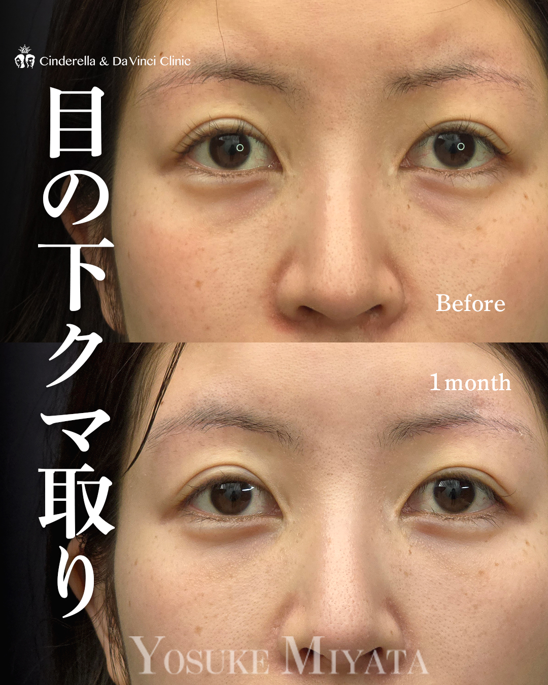 クマ取り(ハムラ法)