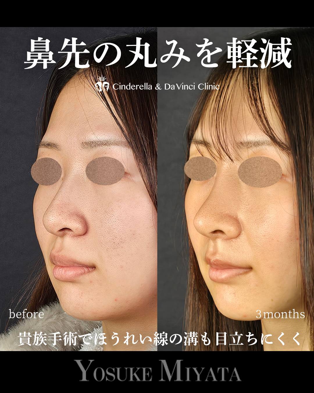 鼻先の丸みを軽減の画像