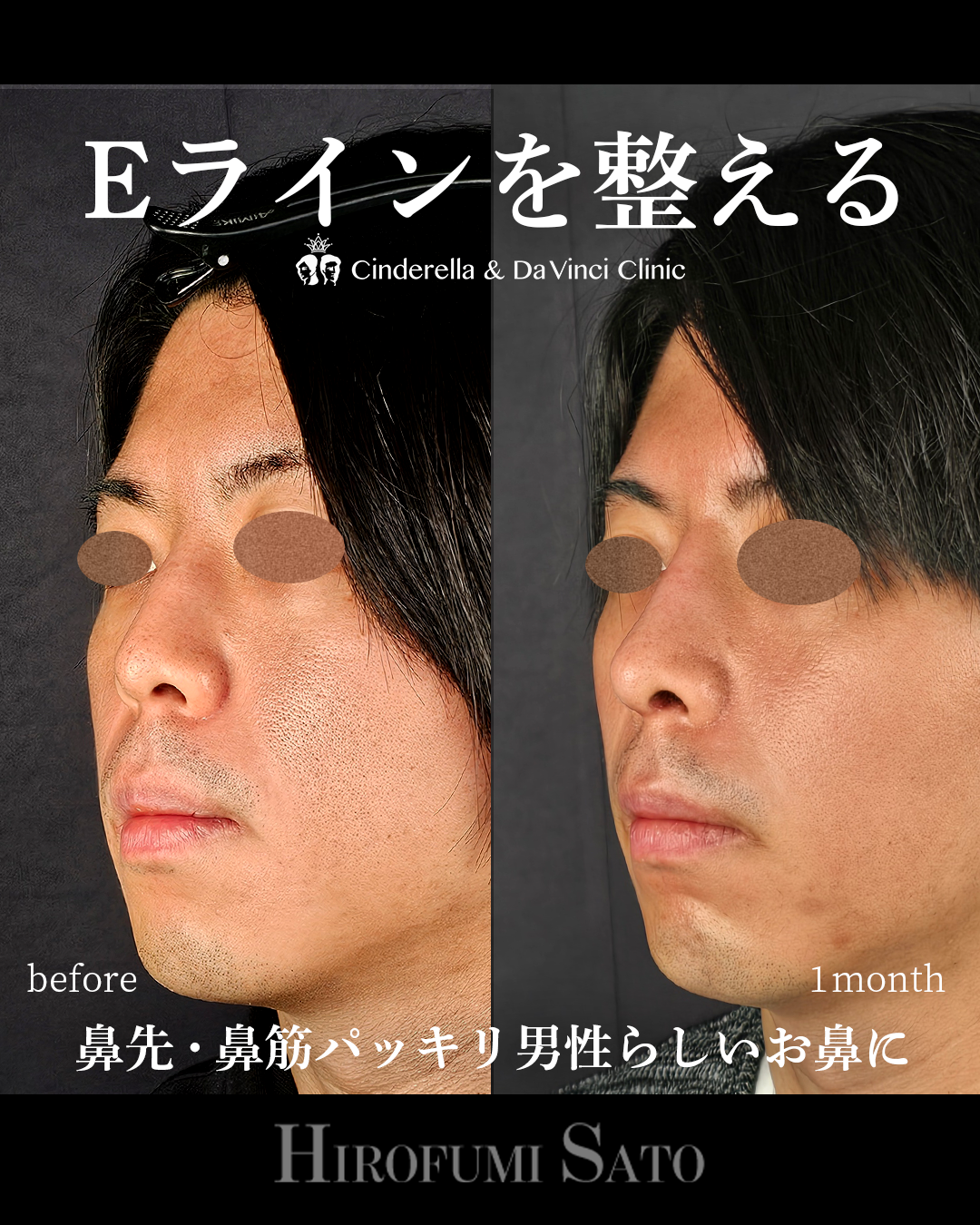 男性の鼻整形の画像