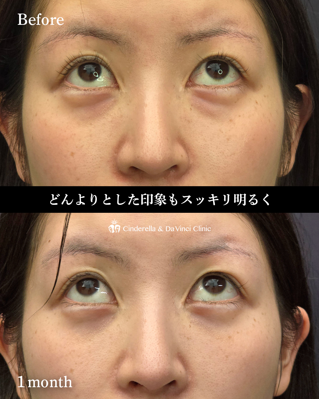 クマ取り(ハムラ法)の画像