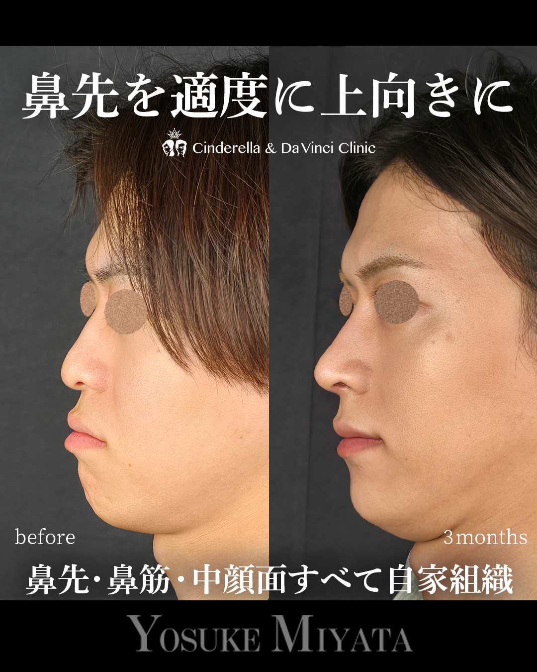 鼻先の角度を上にの画像
