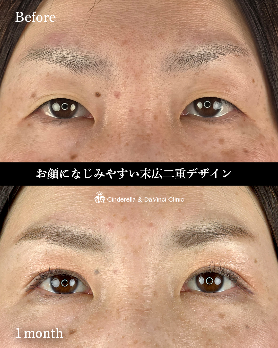 末広二重でもぱっちりの画像