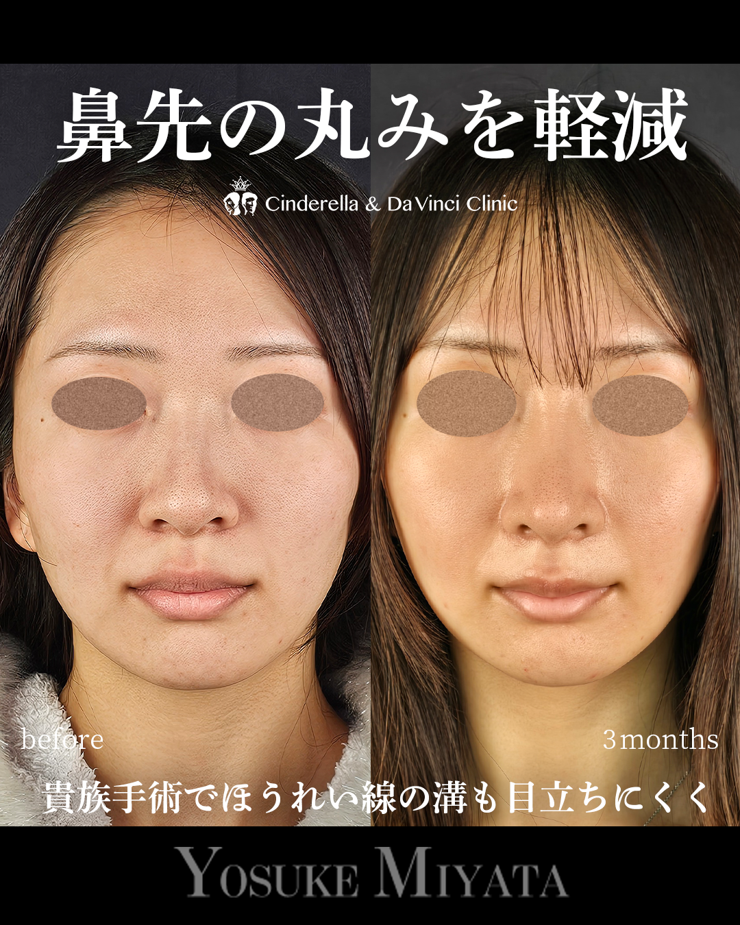 鼻先の丸みを軽減の画像
