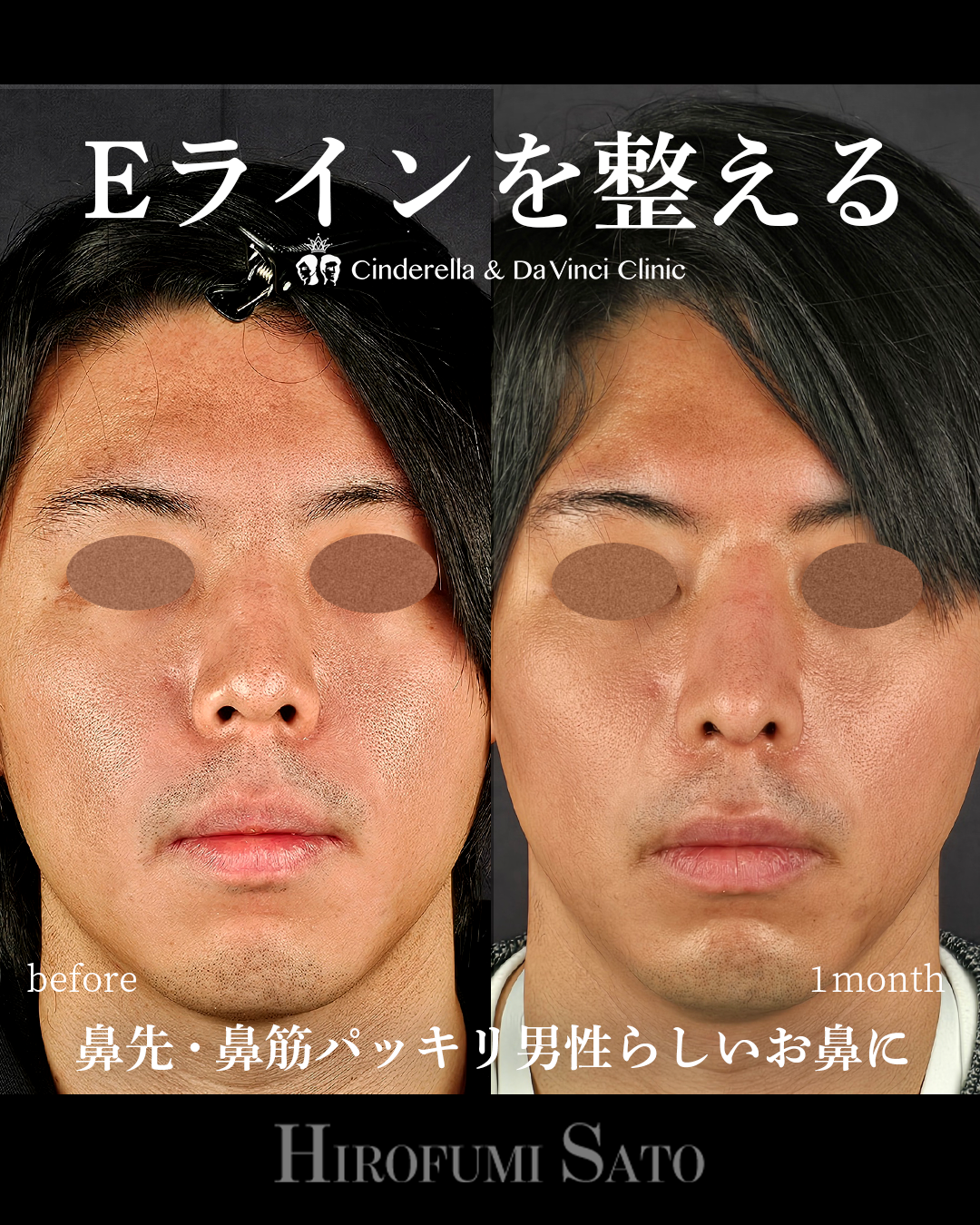 男性の鼻整形の画像