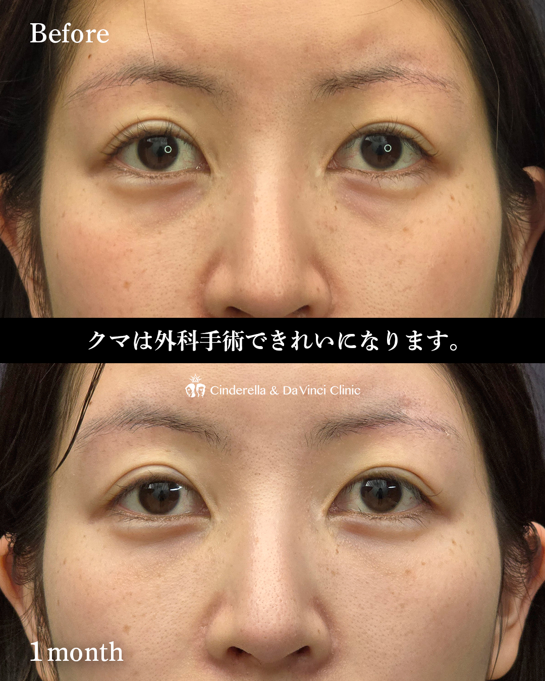 クマ取り(ハムラ法)の画像