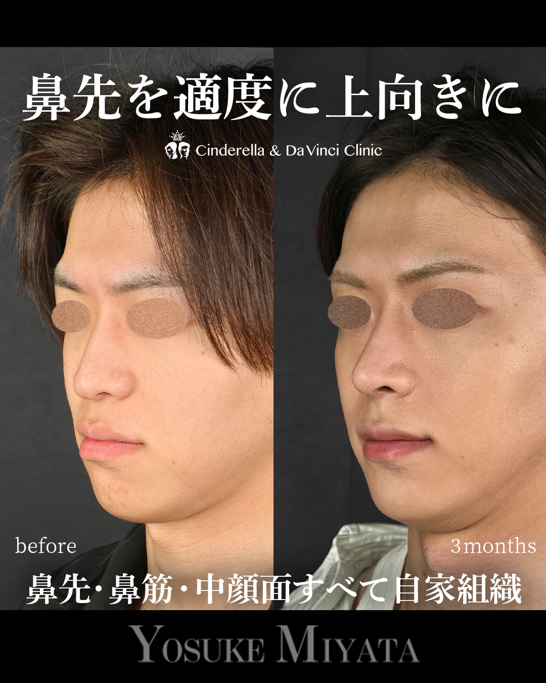 鼻先の角度を上にの画像