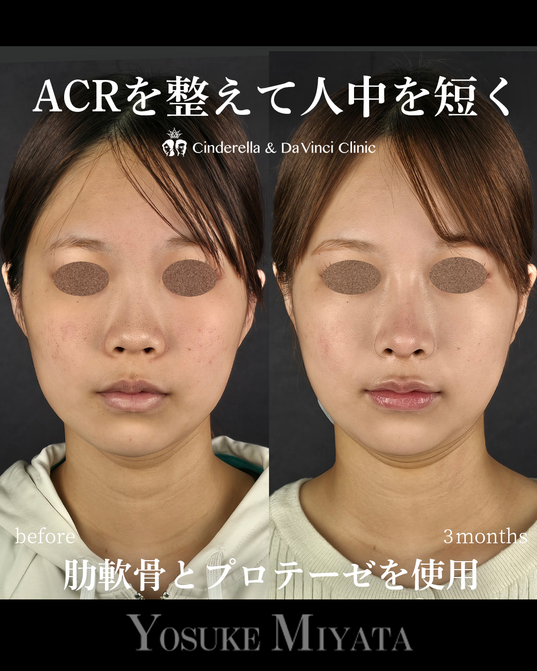 ACRを整えて人中を短くの画像
