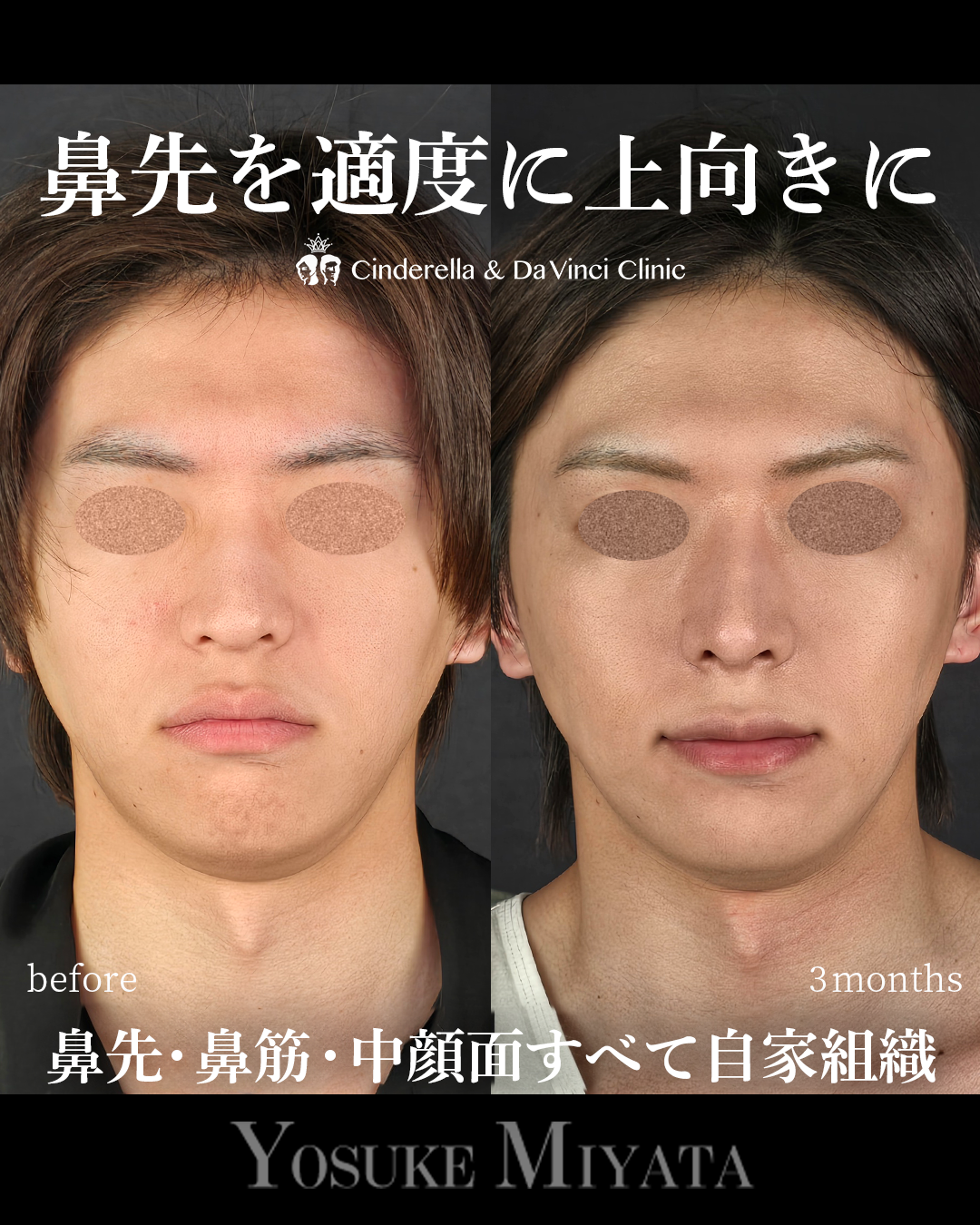 鼻先の角度を上にの画像