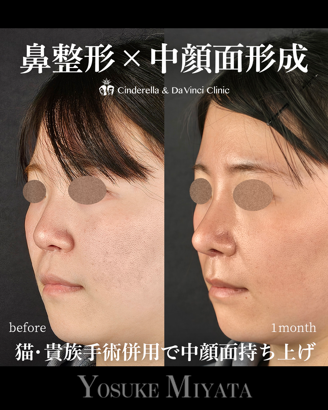 猫手術と貴族手術の画像