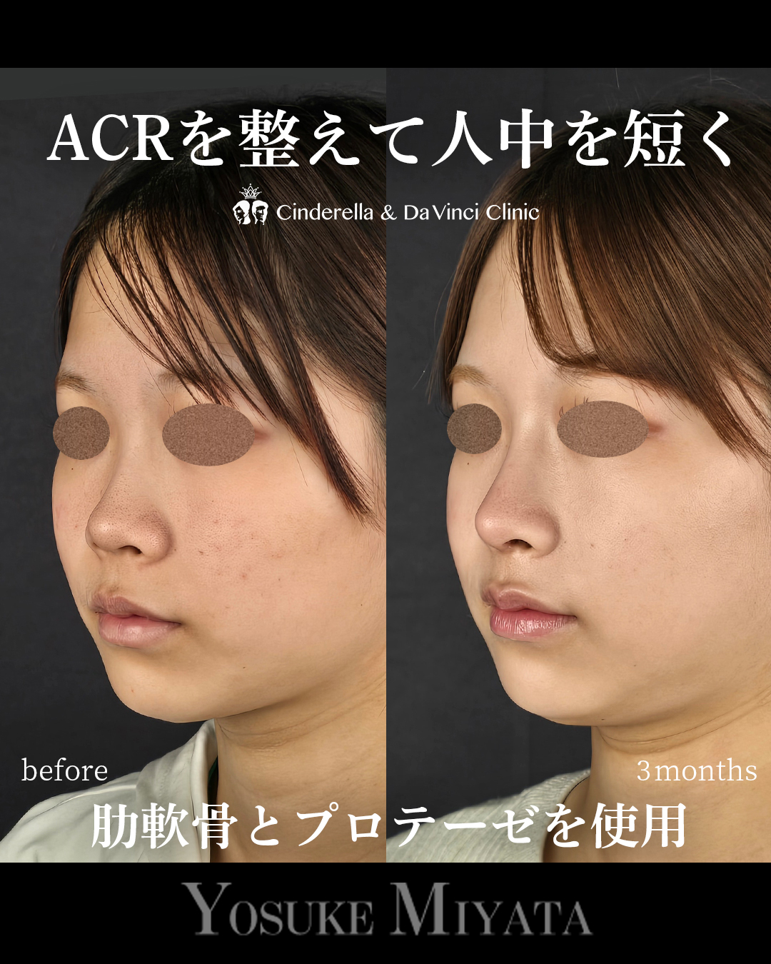 ACRを整えて人中を短くの画像