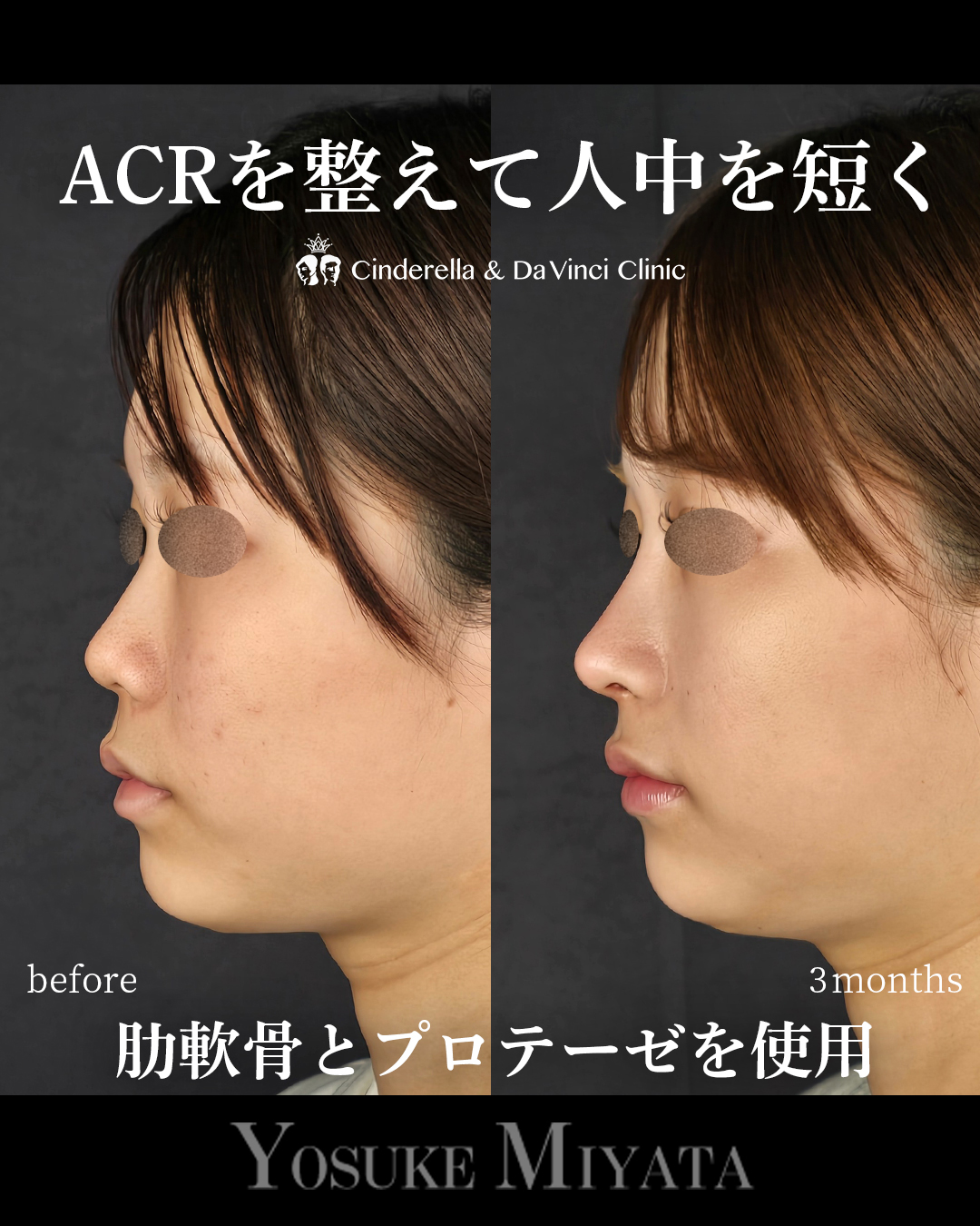 ACRを整えて人中を短くの画像