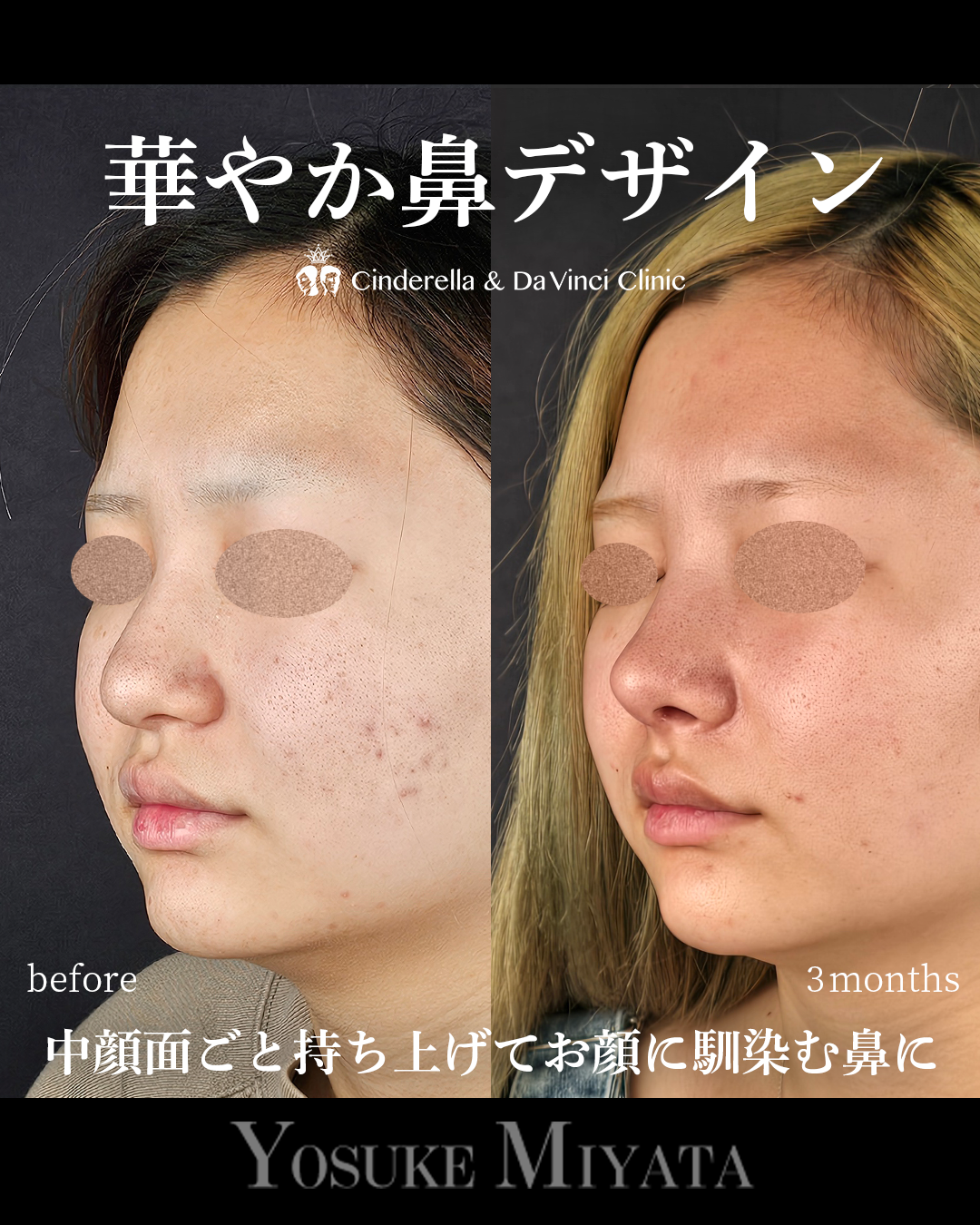 華やか鼻の画像
