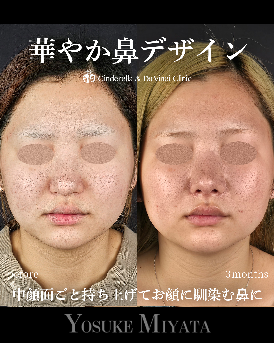 華やか鼻の画像
