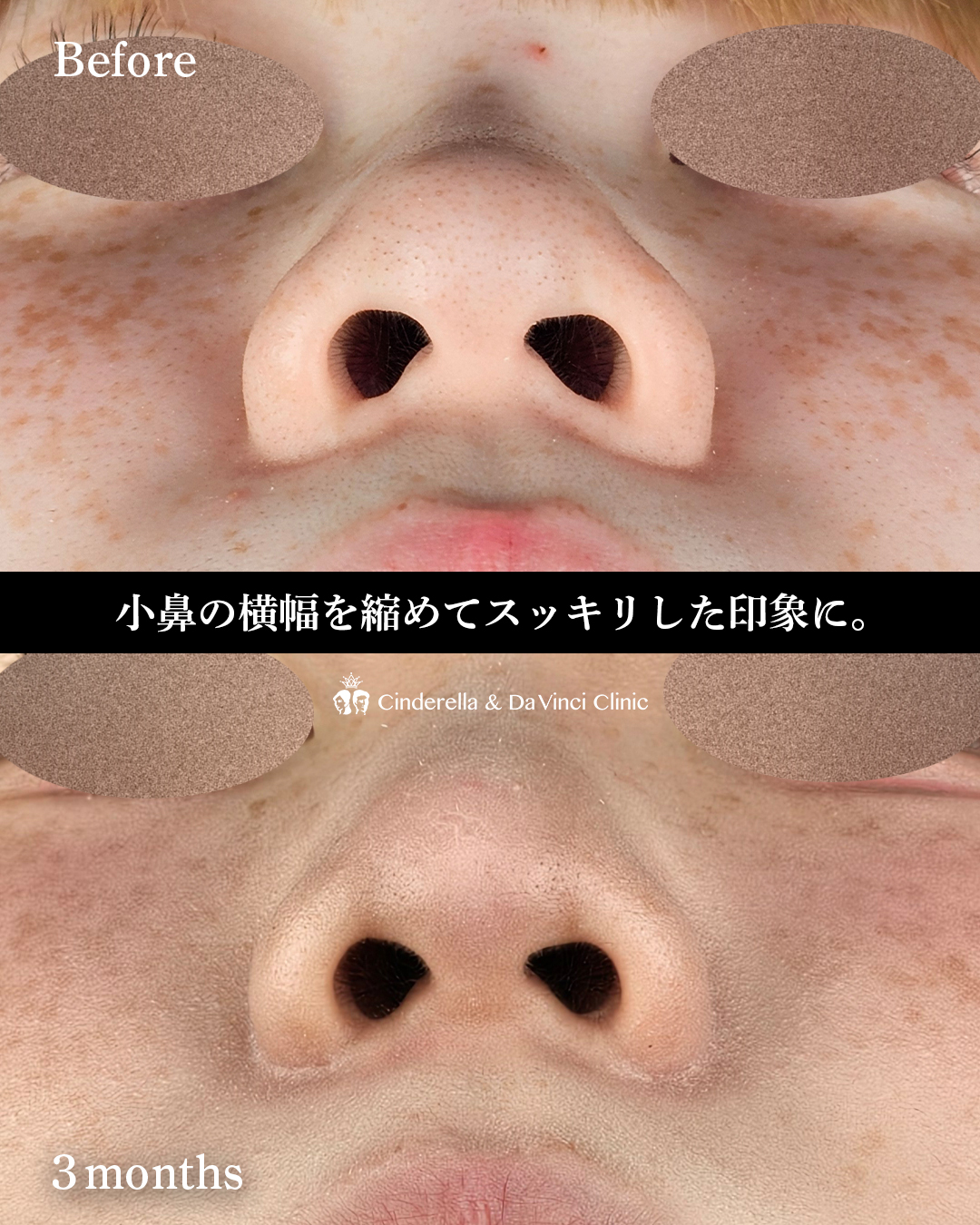 鼻翼縮小のみの画像
