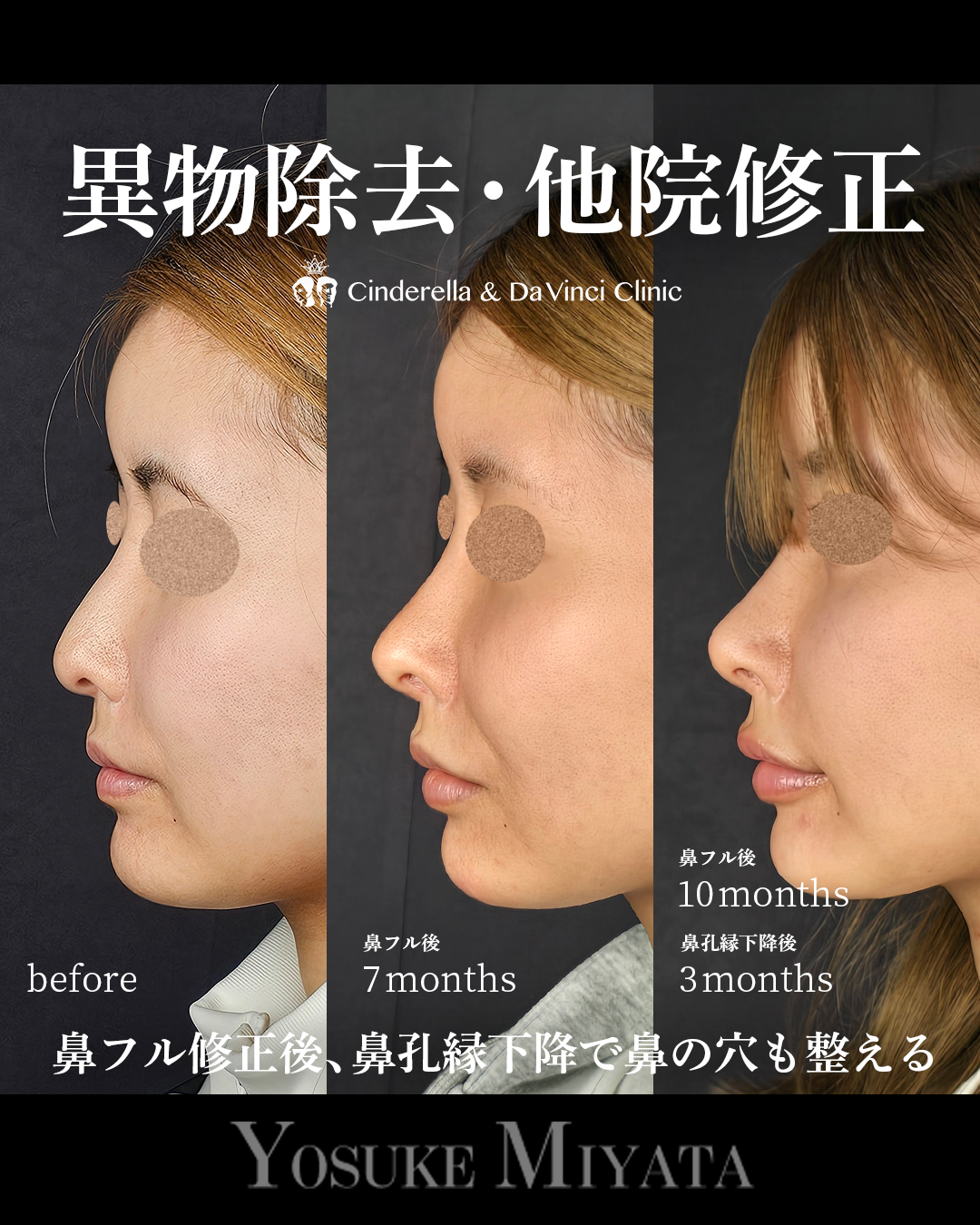 鼻の修正と鼻孔縁下降の画像