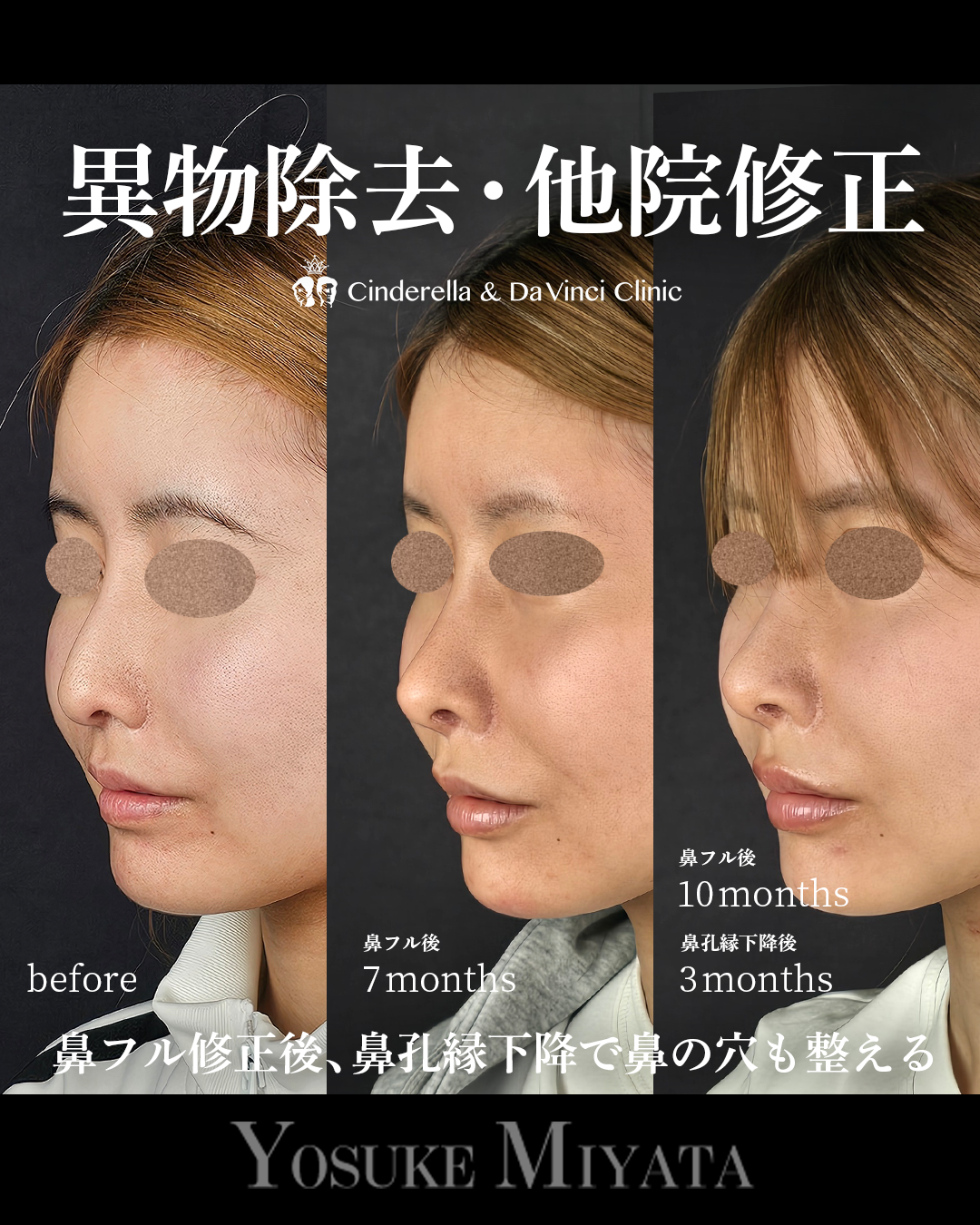 鼻の修正と鼻孔縁下降の画像