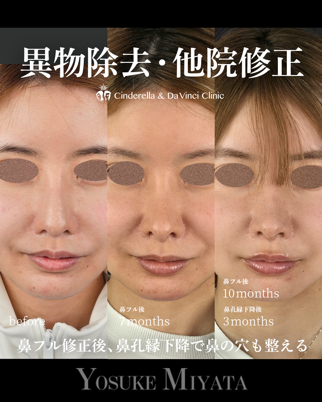鼻の修正と鼻孔縁下降の画像