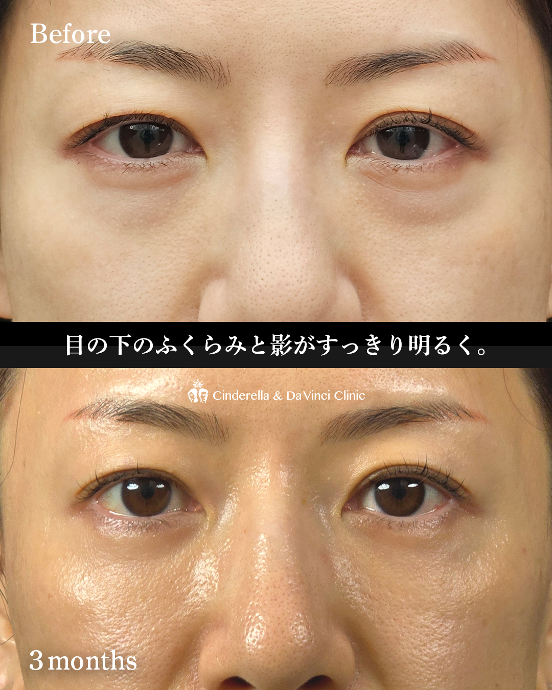 目の下若返りの画像