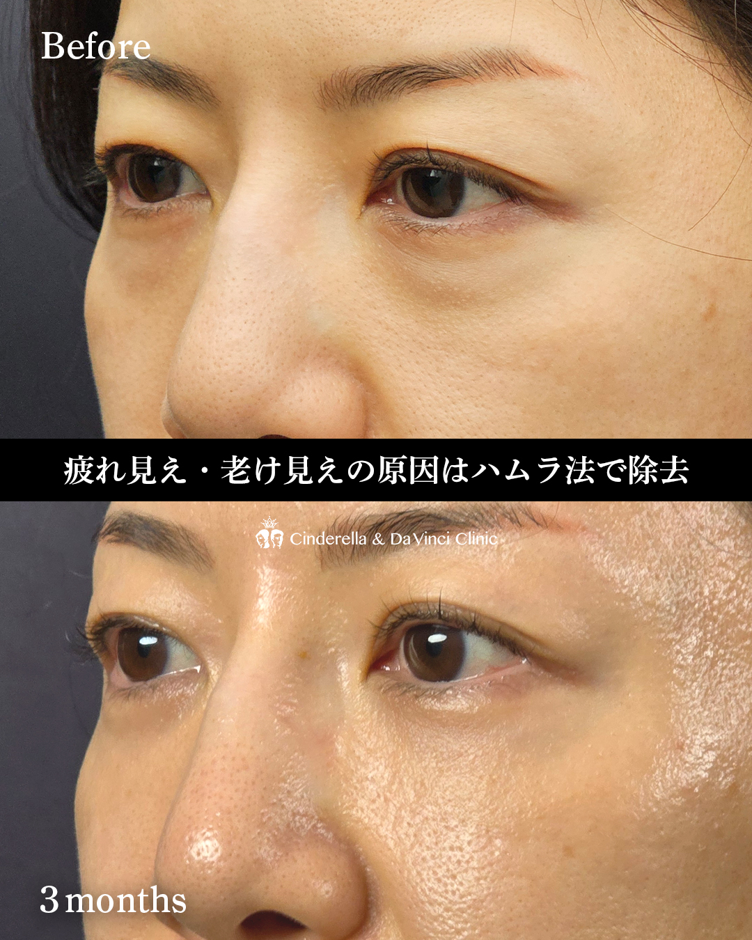 目の下若返りの画像