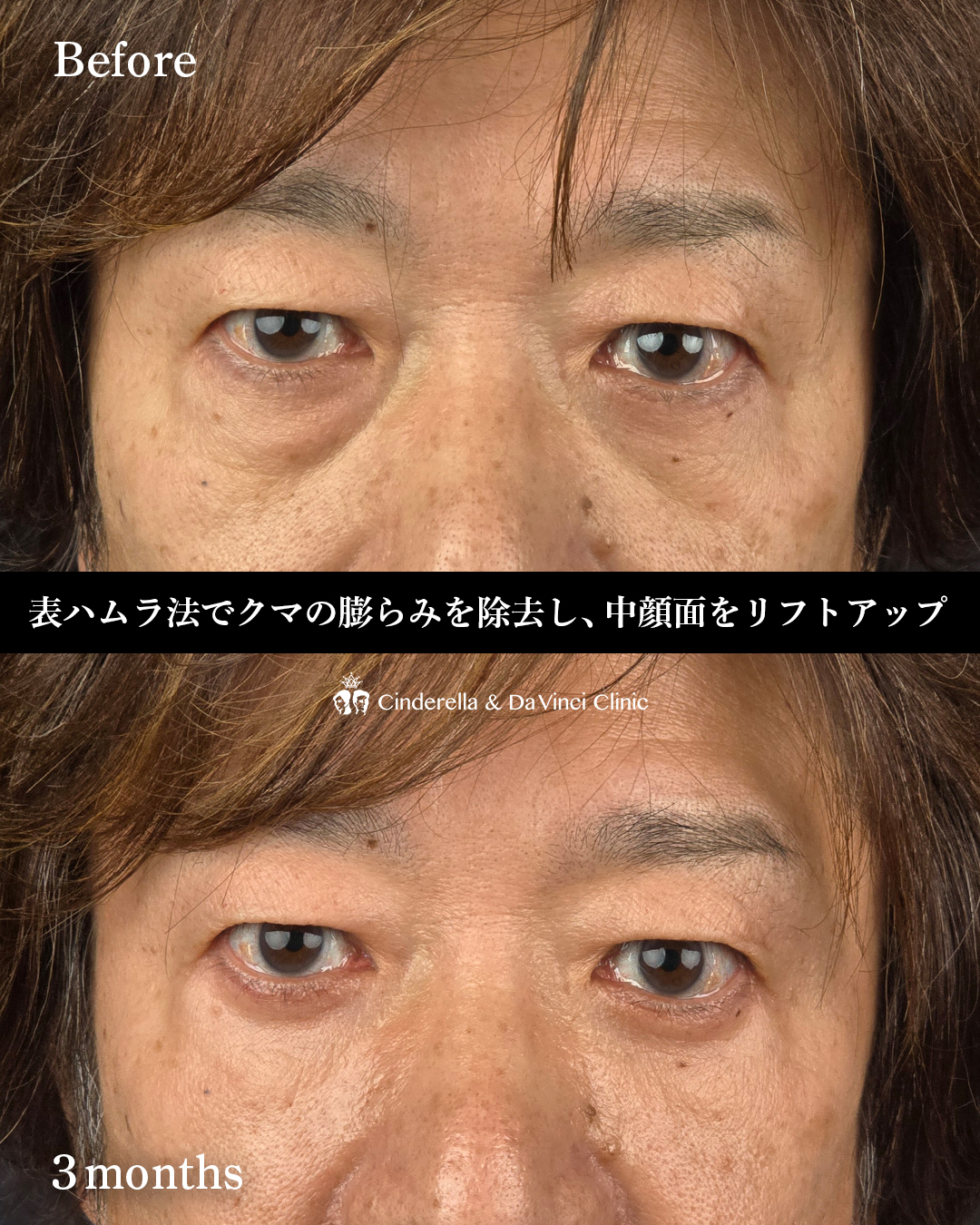 ハムラ法と中顔面リフトの画像