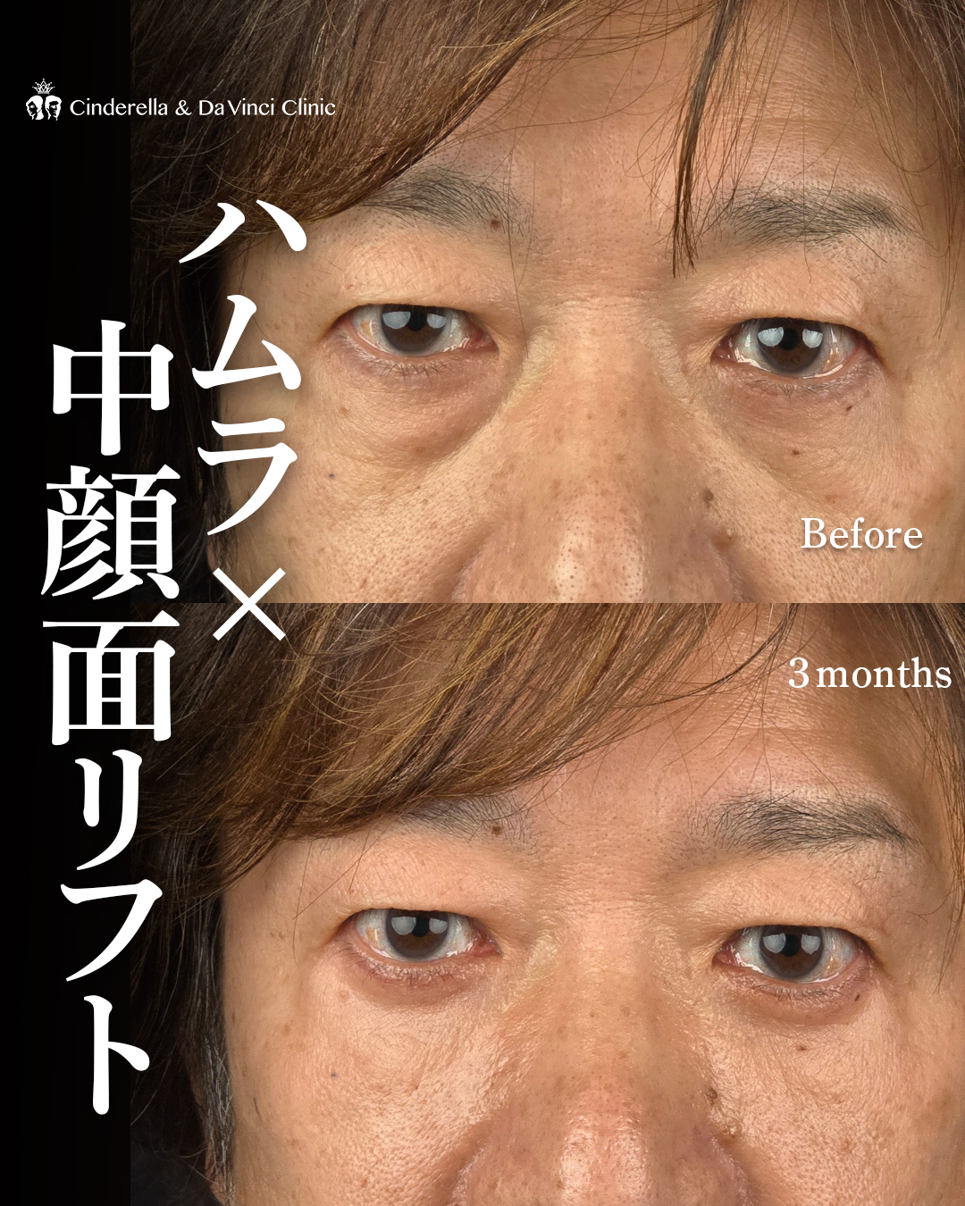 ハムラ法と中顔面リフト