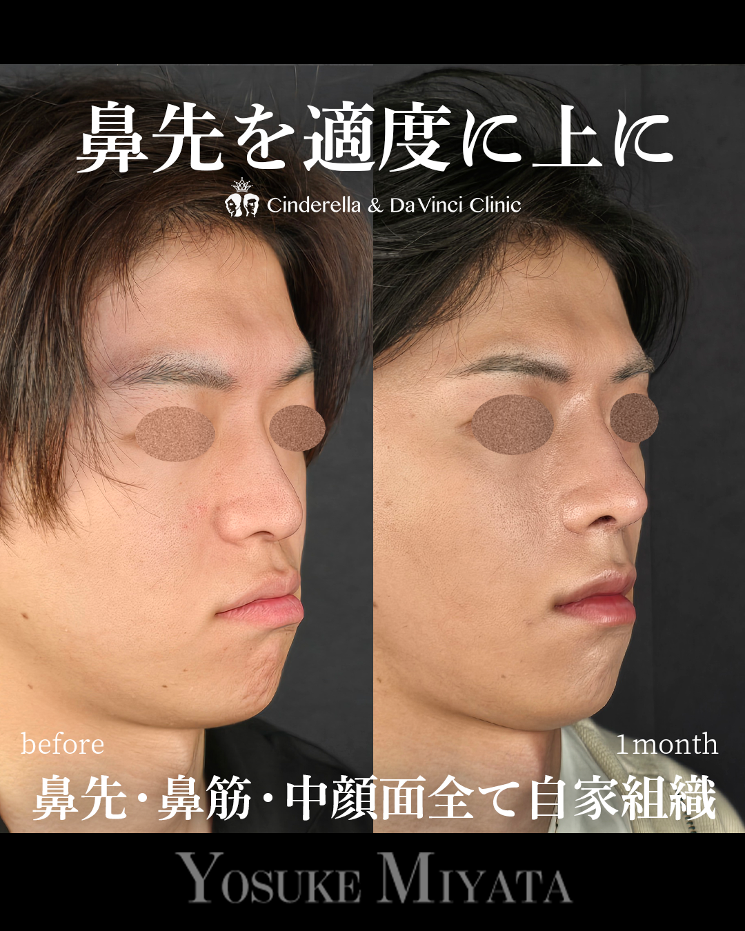 鼻先の角度を上にの画像