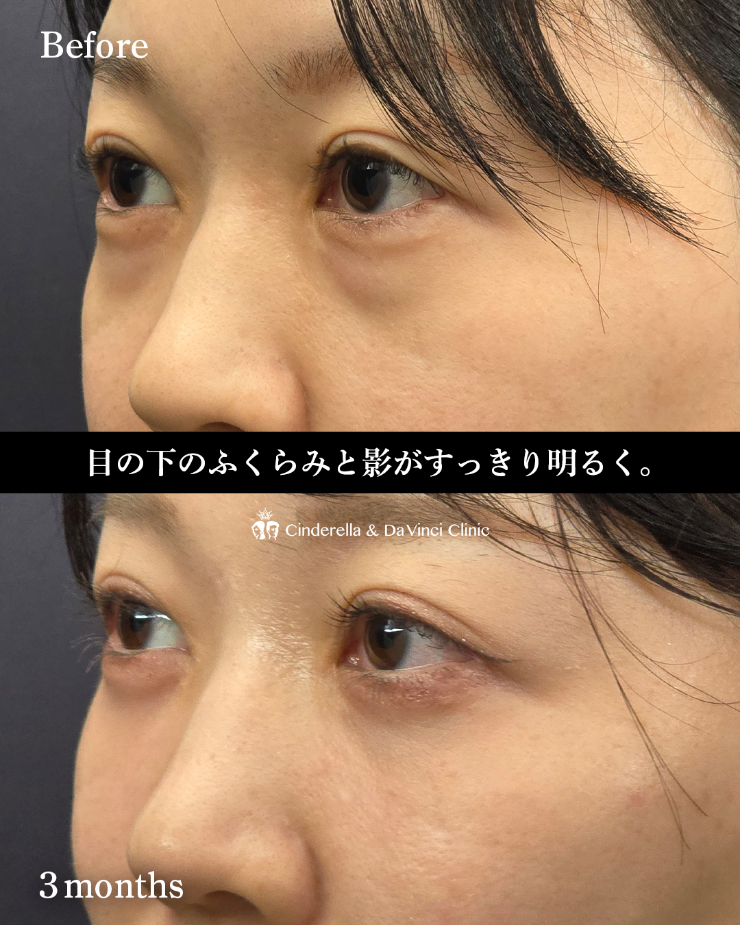クマ取り(裏ハムラ法)の画像