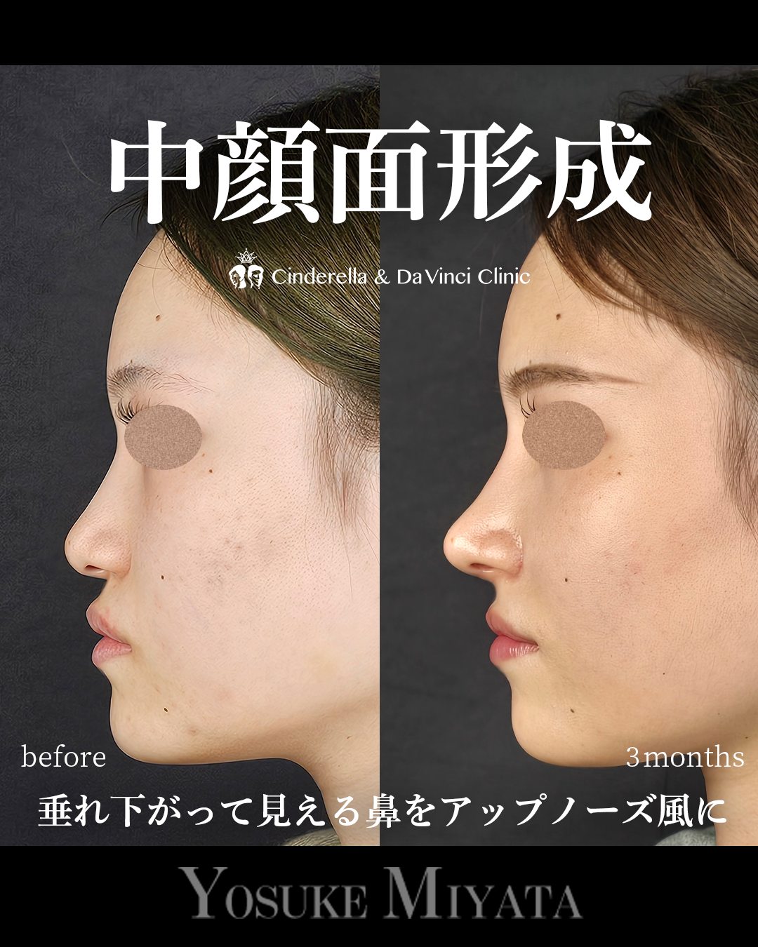 中顔面形成の画像