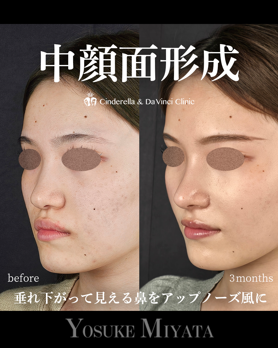 中顔面形成の画像