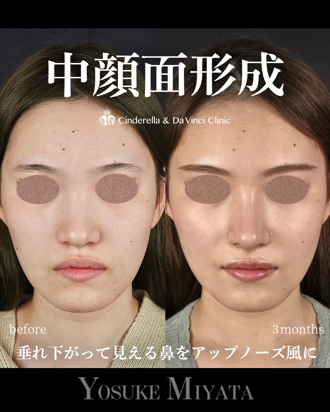 中顔面形成の画像