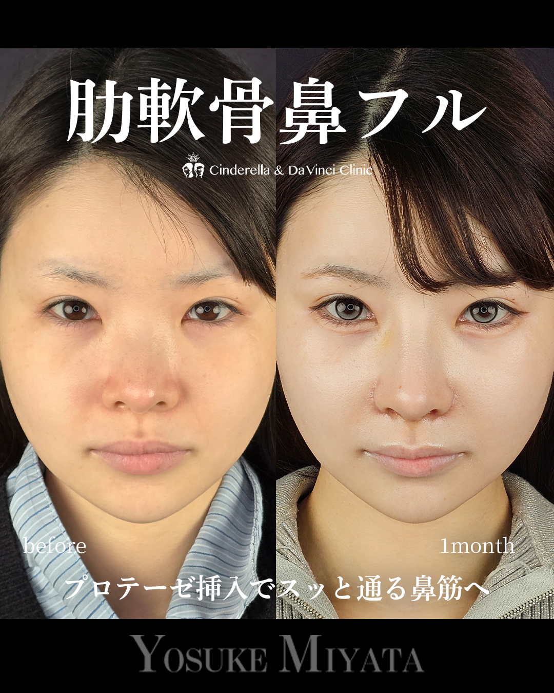 忘れ鼻をつくる