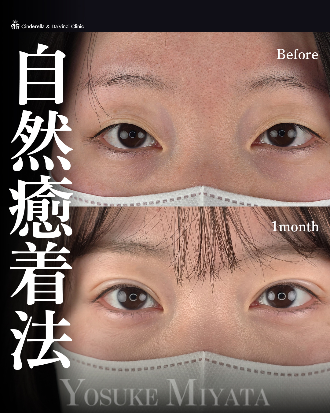 埋没でパッチリ