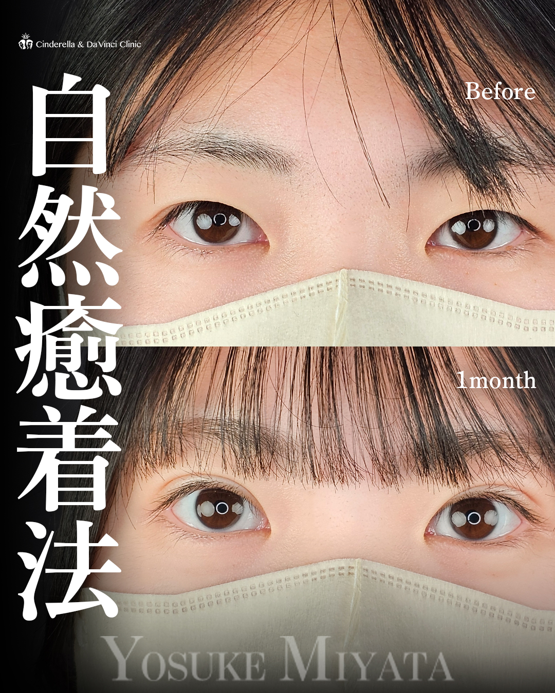 可愛らしいぱっちり二重