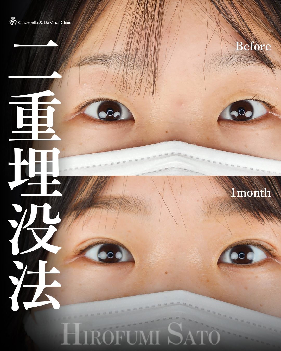 自然な二重に