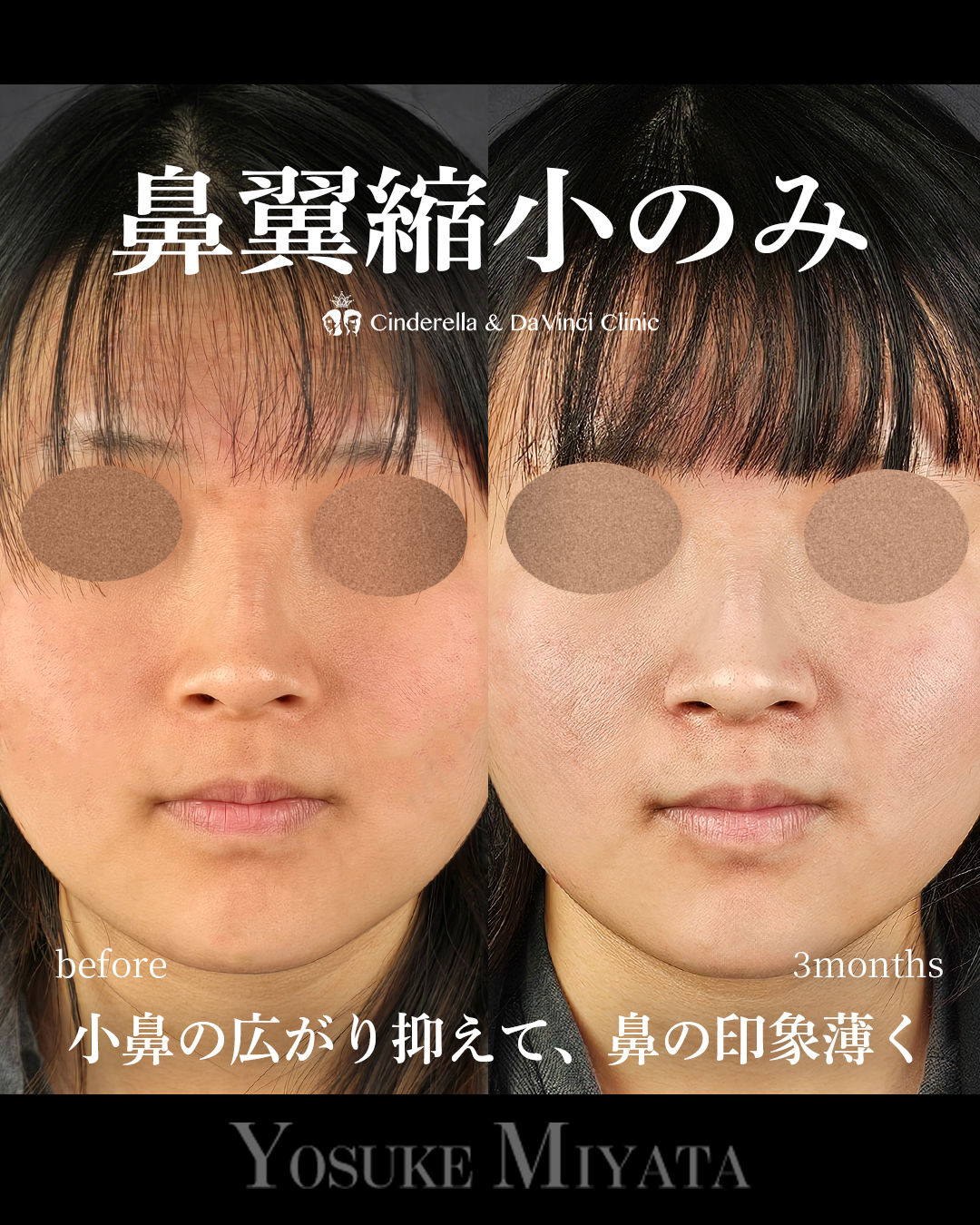 鼻翼縮小のみ