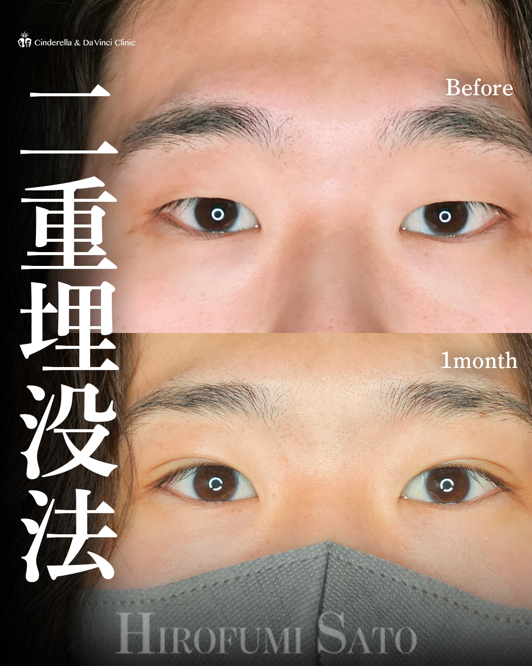 男性の自然な二重