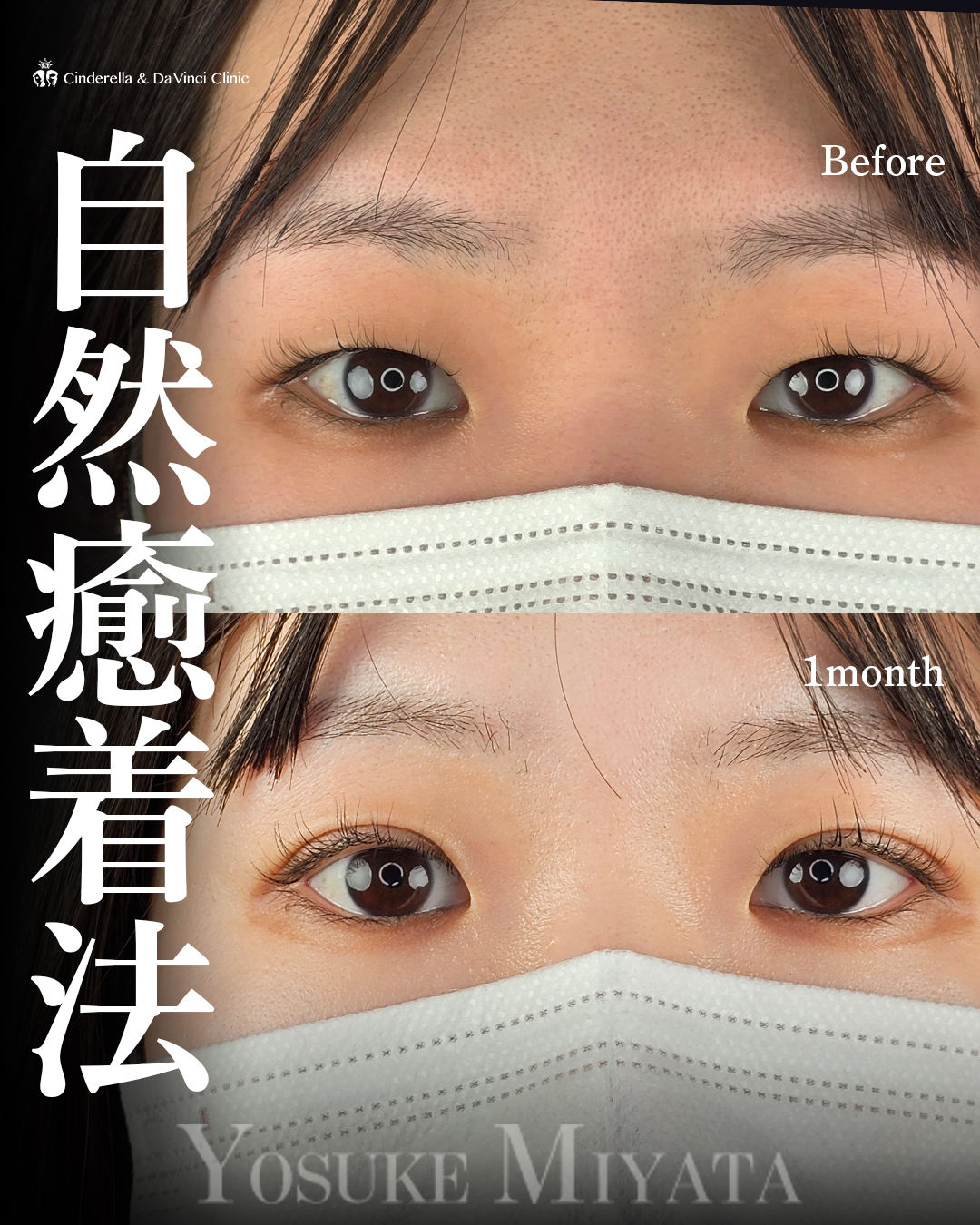 自然な末広二重に