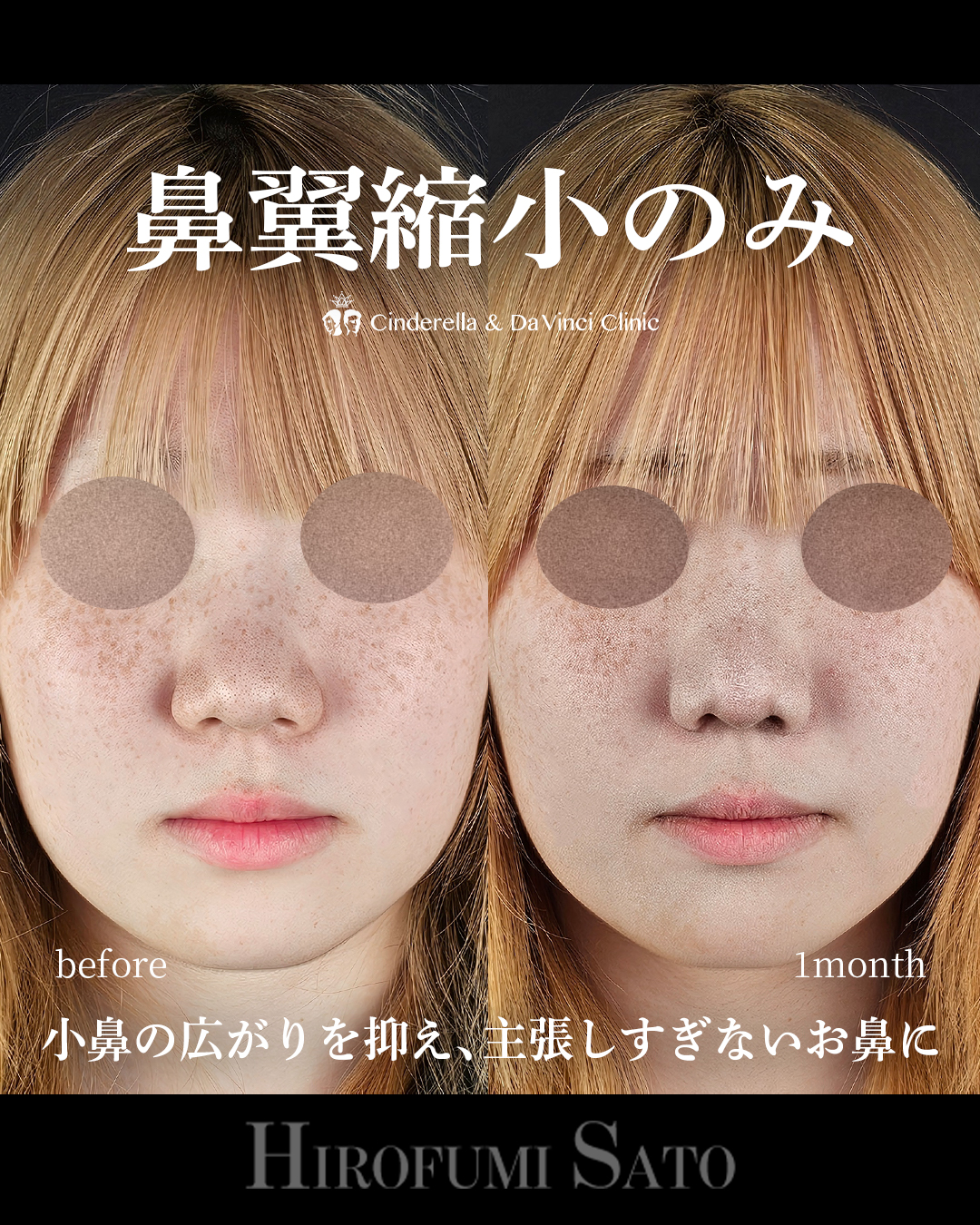 鼻翼縮小のみ