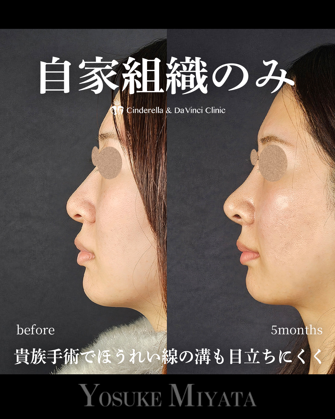 鼻先の丸みを軽減の画像