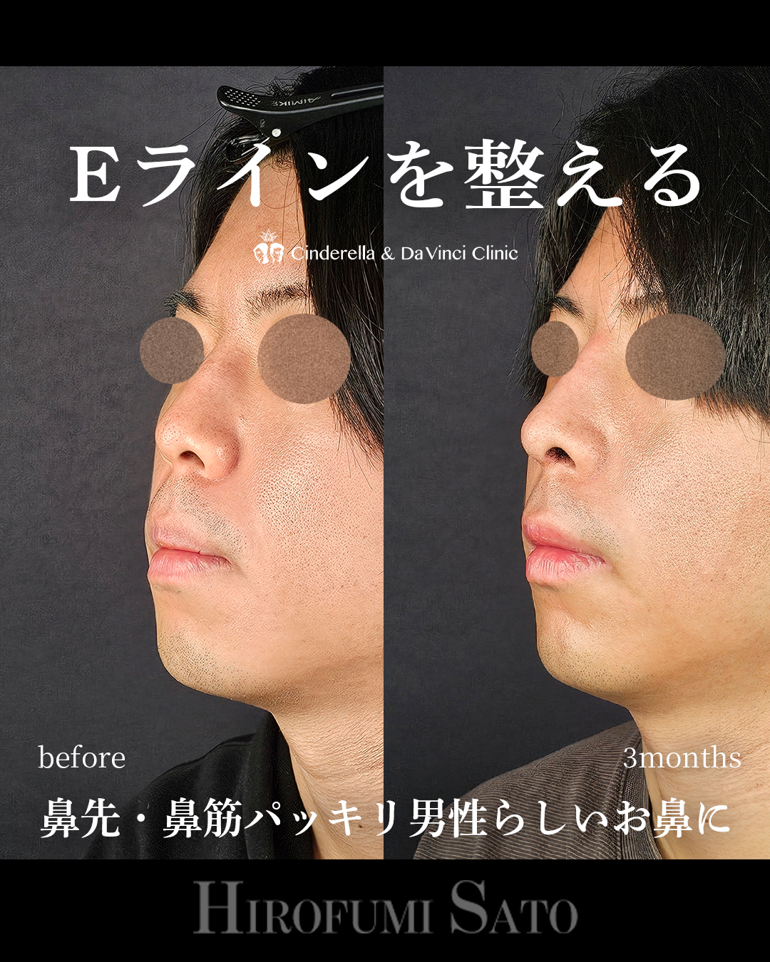 男性の鼻整形の画像