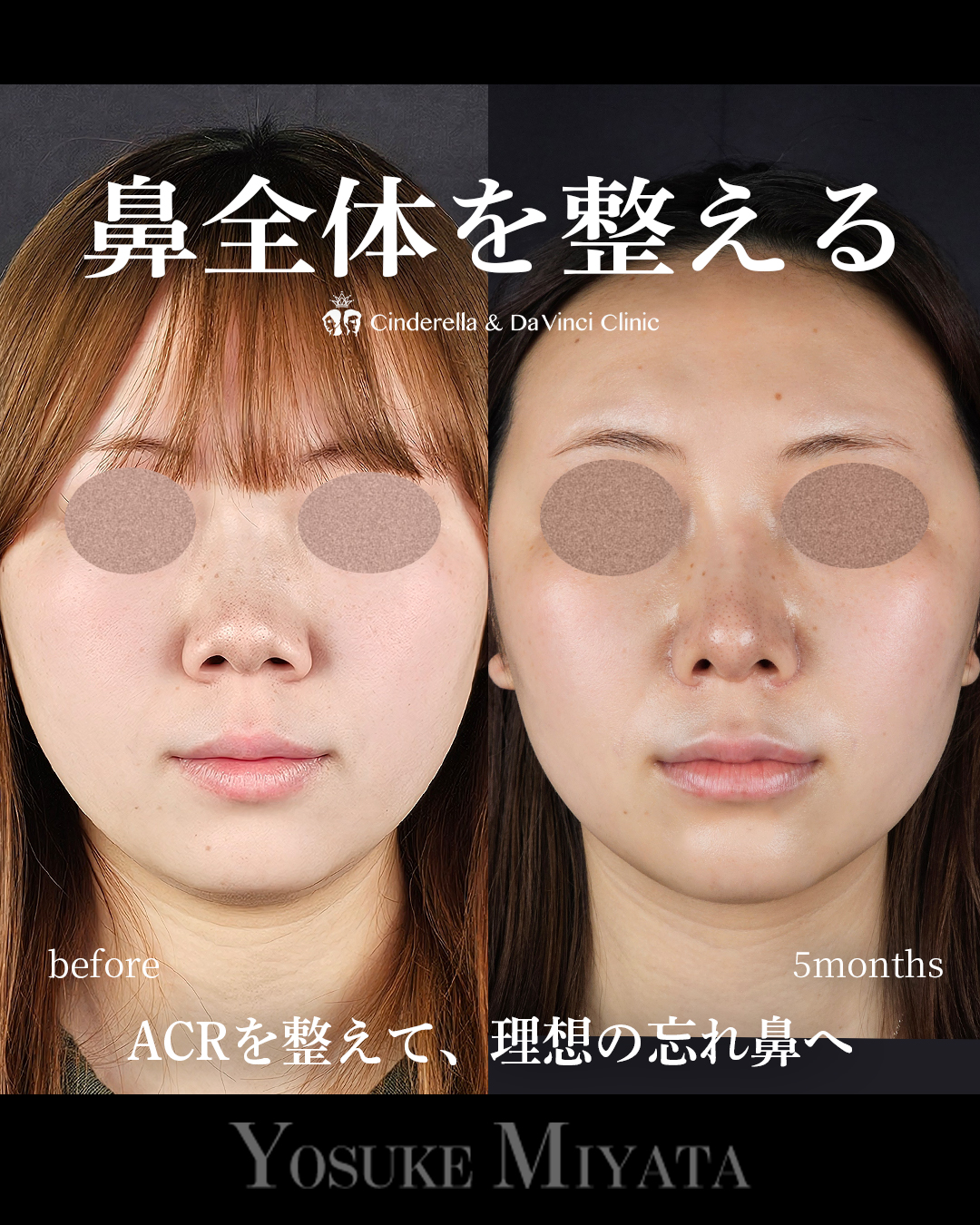鼻全体を整えるの画像